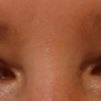 Jeffrey Joseph, MD - After - Cosmetic Surgeons Near Me - Newport Beach, California