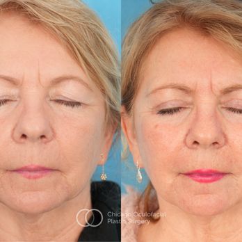 Chicago Oculofacial Plastic Surgery - Before and after quad blepharoplasty and CO2 laser resurfacing - Plastic Surgeons Near Me - Chicago, Illinois