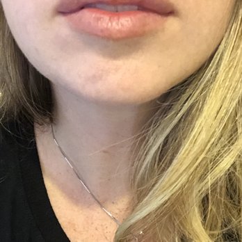 Santa Barbara Plastic Surgery Center - Lip filler with juvaderm - Plastic Surgeons Near Me - Santa Barbara, California Santa Barbara Plastic Surgery Center - Lip filler with juvaderm - Plastic Surgeons Near Me - Santa Barbara, California
