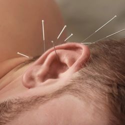 Trinity Village Acupuncture - Aricular Acupuncture