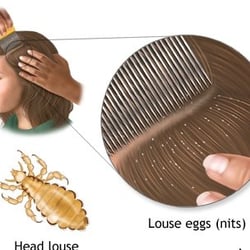 Lice & Easy