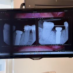 Galindo Prosthodontics - Fixing an implant