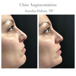 Skin Specifics Medical Spa - Chin projection with dermal filler for profile balance