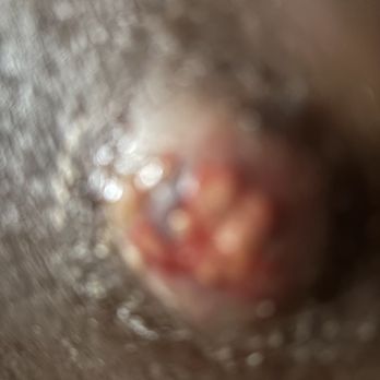 St Johns Episcopal Hospital - Four staphylococcus infections RIGHT KNEE - Hospitals Near Me - Far Rockaway, New York St Johns Episcopal Hospital - Four staphylococcus infections RIGHT KNEE - Hospitals Near Me - Far Rockaway, New York