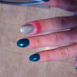 My infected finger I got from getting my nails done at serenity nail on red Bank
