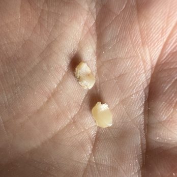 Shoreline Dental Studio - Piece of my tooth that fell out and the filling that fell out - General Dentistry Near Me - Fort Walton Beach, Florida Shoreline Dental Studio - Piece of my tooth that fell out and the filling that fell out - General Dentistry Near Me - Fort Walton Beach, Florida