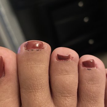 Yvonne's Nails - The scabs on my foot where I got cut when getting my pedicure done and as the grouchy lady was removing the gel off my toes. - Nail Salons Near Me - Fremont, California