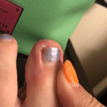 Gaia Nails - Infected ingrown toe nail - Nail Salons Near Me - Benicia, California Gaia Nails - Infected ingrown toe nail - Nail Salons Near Me - Benicia, California
