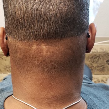 Royal Scalp Micro - Hair Loss Centers Near Me - Albuquerque , New Mexico Royal Scalp Micro - Hair Loss Centers Near Me - Albuquerque , New Mexico