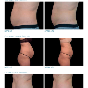 NKD NYC - Body Sculpting: non-invasive, non-surgical, no downtime. - Medical Spas Near Me - New York, New York NKD NYC - Body Sculpting: non-invasive, non-surgical, no downtime. - Medical Spas Near Me - New York, New York