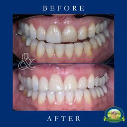 Valley Harvest Dental Care - Patient completed teeth whitening, upper front crowns.