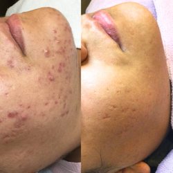 Beautify Your Skin - Acne Scaring before and after skin.ig