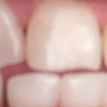 Lombard Smiles - Crack tooth fill in with resin composite I believe from Drs direction and researching this dental offices website. - General Dentistry Near Me - Portland, Oregon Lombard Smiles - Crack tooth fill in with resin composite I believe from Drs direction and researching this dental offices website. - General Dentistry Near Me - Portland, Oregon