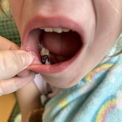 Lone Star Pediatric Dental & Braces - Crown