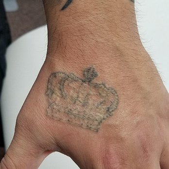Reset Tattoo Removal - After first Tattoo Removal session. - Tattoo Removal Near Me - Las Vegas, Nevada Reset Tattoo Removal - After first Tattoo Removal session. - Tattoo Removal Near Me - Las Vegas, Nevada
