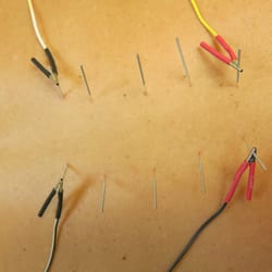 Oregon City Acupuncture - Electrical - Estim treatment