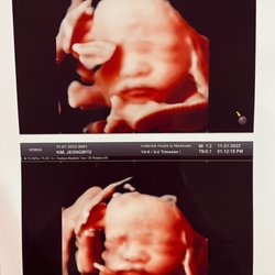 Forever Yours Ultrasound - Baby cabong