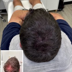 Scalp MicroPigmentation of California - Density build.