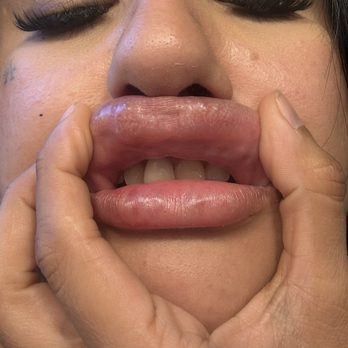 Td Aesthetics - Pockets of filler injected improperly . This is not at all how your lips should look after filler! - Medical Spas Near Me - Los Angeles, California Td Aesthetics - Pockets of filler injected improperly . This is not at all how your lips should look after filler! - Medical Spas Near Me - Los Angeles, California