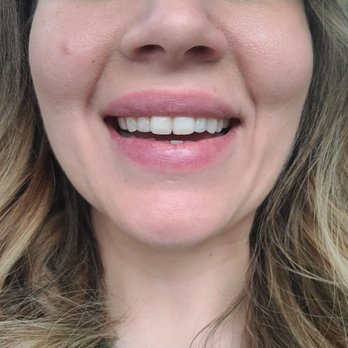 Raptis Orthodontics - Progress so far!! Almost there...after picture to be posted - Orthodontists Near Me - Bristol, Connecticut