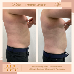 Belle Ame Med Spa & Boutique - Immediately after 1 session of Ultimate Contour Treatment