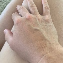 Walgreens - Swollen hand infection desperate for antibiotic.