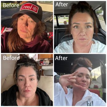Michael D Mirmanesh, MD - Before and 2.5 months after procedure. - Cosmetic Surgeons Near Me - Pinellas Park, Florida
