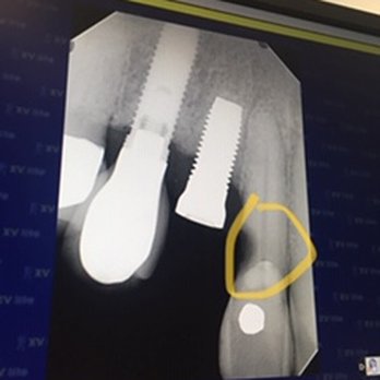 CJ Dental - The implant is a mess.   The circle shows how it destroyed a perfectly good tooth. - Cosmetic Dentists Near Me - Vista, California