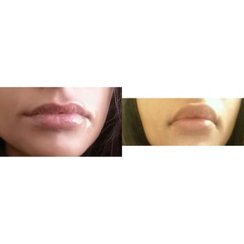 Great Neck Medical Spa - Before after swolen but you can see fullness. - Medical Spas Near Me - Great Neck, New York Great Neck Medical Spa - Before after swolen but you can see fullness. - Medical Spas Near Me - Great Neck, New York