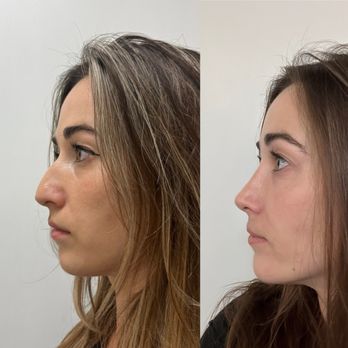 Vladimir Grigoryants, MD - Before & after rhinoplasty - Cosmetic Surgeons Near Me - Glendale, California Vladimir Grigoryants, MD - Before & after rhinoplasty - Cosmetic Surgeons Near Me - Glendale, California