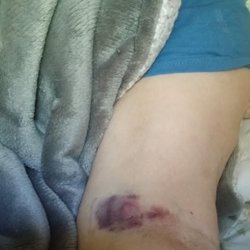 West Virginia University Hospitals-East - A bruise incurred when angry nurse yanked out my IV.