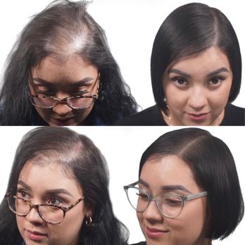 Reshade Scalp Micropigmentation - Scalp Micropigmentation for density on a female - Hair Loss Centers Near Me - Brooklyn, New York Reshade Scalp Micropigmentation - Scalp Micropigmentation for density on a female - Hair Loss Centers Near Me - Brooklyn, New York