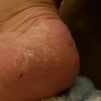 Palace Nail Lounge - This is one cut on my other foot. - Nail Salons Near Me - Mesa, Arizona