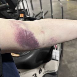 CSL Plasma - Worsening bruise from a botched draw.