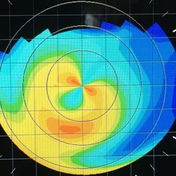 The Keratoconus Center of Long Island - A typical keratoconus corneal map result.