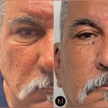Makeup Mau Loa - Skin needling. Look how much smoother he is! - Eyebrow Services Near Me - Valley Springs , California Makeup Mau Loa - Skin needling. Look how much smoother he is! - Eyebrow Services Near Me - Valley Springs , California