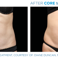 Allure Medical Spa - BTL: Core to Floor
(EmSella and EmSculpt)