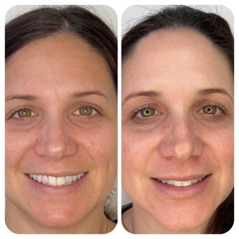 Skinbeam Aesthetics - Before any treatment (left), after PRP facial and Dysport injections in forehead (right) - Medical Spas Near Me - Orange, California