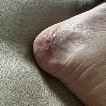 iColor Nail Bar - Pedicure injury - Nail Salons Near Me - Belmont, North Carolina iColor Nail Bar - Pedicure injury - Nail Salons Near Me - Belmont, North Carolina
