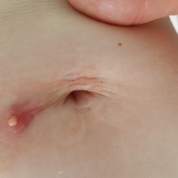 Sydney CBD Medical Centre - 3 weeks later!!! I complained they werent stitched properly and was only patronised!!! Now look!! - Oncologist Near Me - Sydney, NSW Sydney CBD Medical Centre - 3 weeks later!!! I complained they werent stitched properly and was only patronised!!! Now look!! - Oncologist Near Me - Sydney, NSW