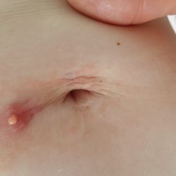 Sydney CBD Medical Centre - 3 weeks later!!! I complained they werent stitched properly and was only patronised!!! Now look!!