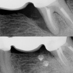 Peiman Soleymani, DDS - Advanced periodontal regeneration to save a hopeless tooth holding a bridge