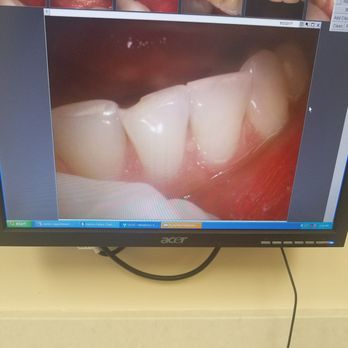 David Abri, DDS - Chip from eating a seed - General Dentistry Near Me - Los Angeles, California