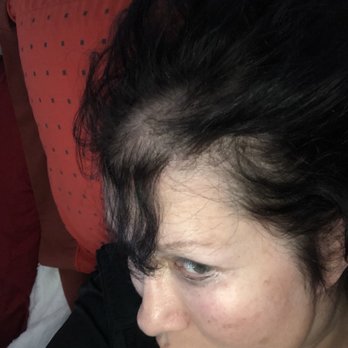Metropolitan Plastic Surgery - My so-called hairline lowering - Cosmetic Surgeons Near Me - St Louis, Missouri Metropolitan Plastic Surgery - My so-called hairline lowering - Cosmetic Surgeons Near Me - St Louis, Missouri