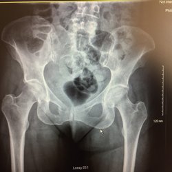 Eisenhower Primary Care - Palm Desert - Broken pelvis. Hmmm, says the Dr.