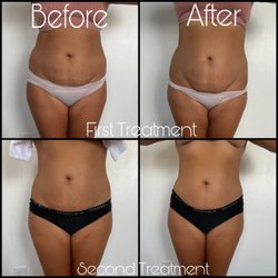 Body Aesthetics HI - Before and After pictures of client after two treatments.