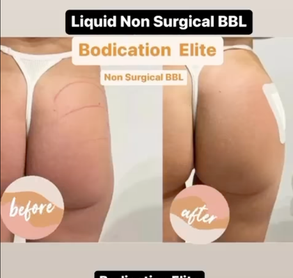 Non Surgical BBL - Bodication Elite LLC is your vacation place day spa here to serve the Dallas/Ft Worth Area. You are in the right place if you have been looking for Post Op care after cosmetic surgery, we have 5 years of experience. Our services don’t stop there as we offer many other services including body sculpting, injectables, self-care and so much more. So if you are ready to trust us with your body then continue to check out the website and get ready to get snatch and discover the new you! Non Surgical BBL - Bodication Elite LLC is your vacation place day spa here to serve the Dallas/Ft Worth Area. You are in the right place if you have been looking for Post Op care after cosmetic surgery, we have 5 years of experience. Our services don’t stop there as we offer many other services including body sculpting, injectables, self-care and so much more. So if you are ready to trust us with your body then continue to check out the website and get ready to get snatch and discover the new you!