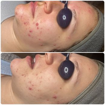 512 Skincare - After 1st treatment. Reducing inflammation and redness due to hormonal acne. - Skin Care Near Me - Austin, Texas 512 Skincare - After 1st treatment. Reducing inflammation and redness due to hormonal acne. - Skin Care Near Me - Austin, Texas
