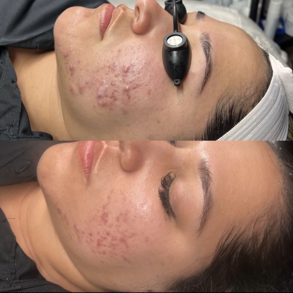 YS Aesthetics - Look how bad and swollen my acne was such a big difference - Skin Care Near Me - Rancho Cucamonga, California YS Aesthetics - Look how bad and swollen my acne was such a big difference - Skin Care Near Me - Rancho Cucamonga, California