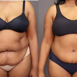 Zannis Plastic Surgery - Tummy tuck in New Bern, NC by Dr. John Zannis body contouring expert